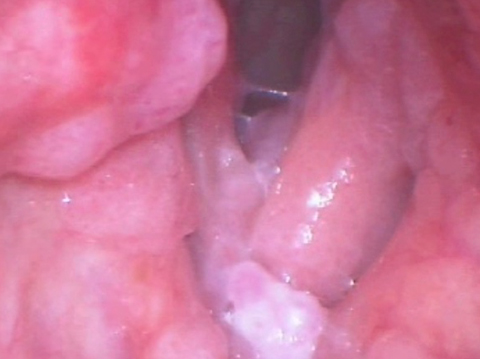 喉乳头状瘤