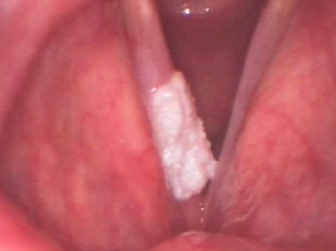 声带白斑病——喉癌